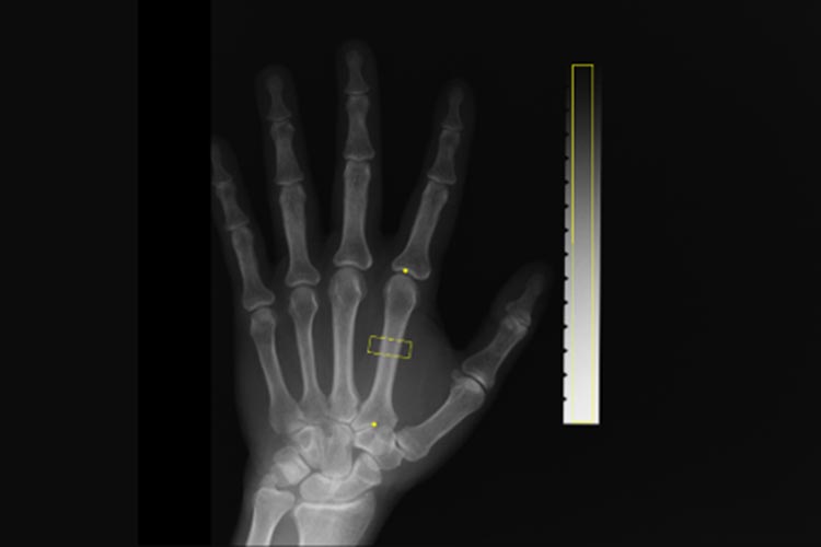 骨密度検査のイメージ